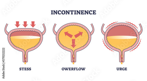 Incontinence problem with stress, owerflow and urge types outline diagram. Labeled educational medical disease with uncomfortable urine causes vector illustration. Body disorder and bladder illness. photo