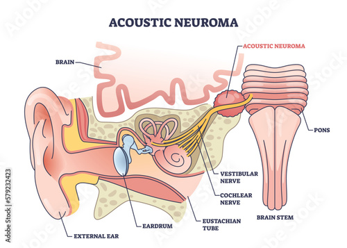 Acoustic neuroma as benign tumor near vestibular nerve outline diagram. Labeled educational ear structure with inner parts and medical disorder diagnosis vector illustration. Balance and hearing loss