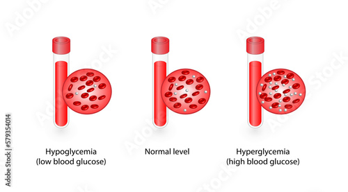 Blood Glucose Levels. Normal level, hypoglycemia (low blood sugar), hyperglycemia (high blood sugar), sugar test. vector diagram	
