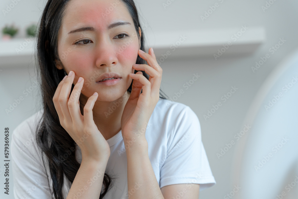 Young woman asian are worried about faces Dermatology and allergic to steroids in cosmetics. sensitive skin, red face from sunburn, acne, allergic to chemicals, rash on face. skin problems and beauty Young woman asian are worried about faces Dermatology and allergic to steroids in cosmetics. sensitive skin, red face from sunburn, acne, allergic to chemicals, rash on face. skin problems and beauty