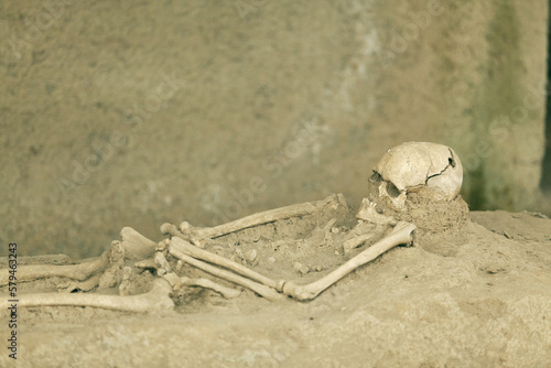 Trepanned skeleton with surgery intervention skull burr hole photo
