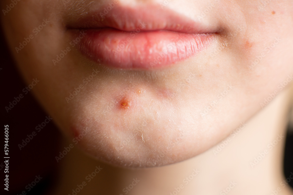 Obraz premium Pimples on chin of teenager girl. Skin problems, adolescence. Close-up.