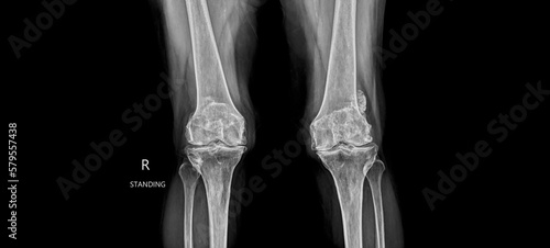 Radiograph on black background in hospital.Doctor used xray for diagnosis of the illness of patient.X-ray of osteoarthritis or oa of knee.Xray shows osteophyte and loose body with knee joint narrow. photo