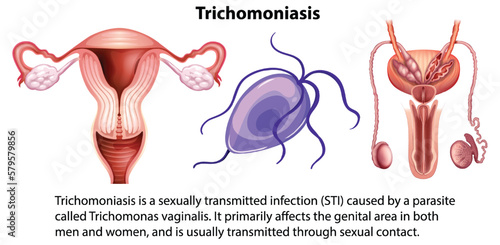 Trichomoniasis infographic with explanation