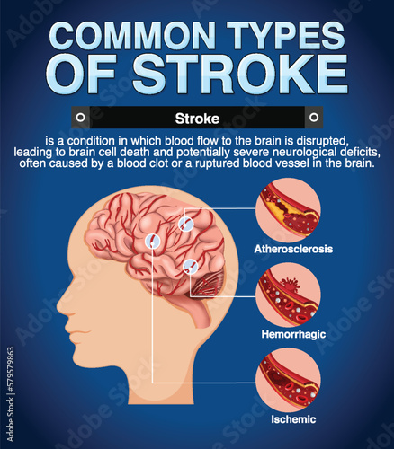 Informative poster of common types of stoke