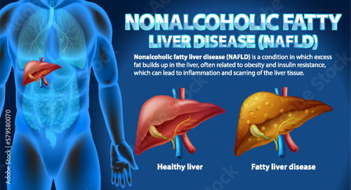 Nonalcoholic Fatty Liver Disease (NAFLD) photo