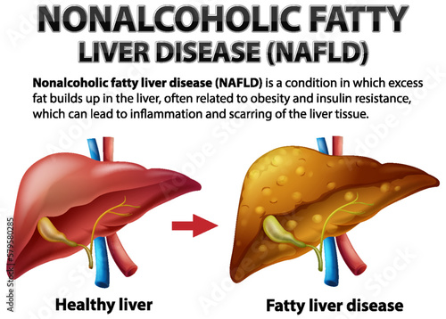 Nonalcoholic Fatty Liver Disease