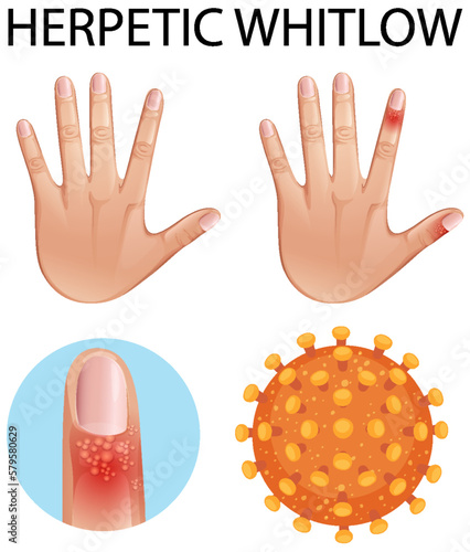Human finger with herpetic whitlow skin disease
