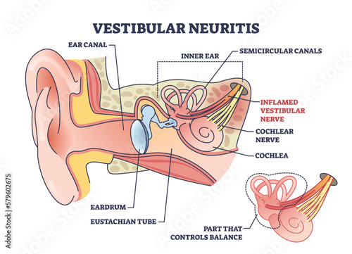 Vestibular neuritis as inner ear nerve inflammation disease outline diagram. Labeled educational medical semicircular canal condition with dizziness, vertigo and balance loss vector illustration. photo