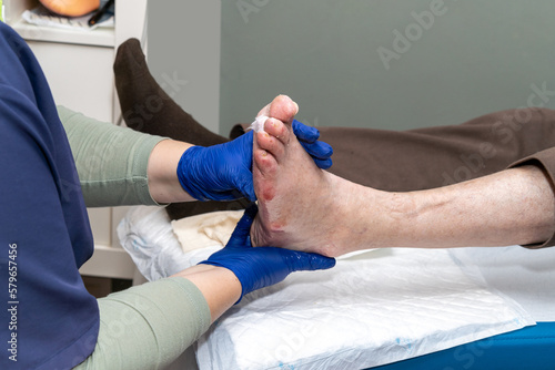 Close up of a nurse examining an older patient's infected foot for curettage. High quality photo photo