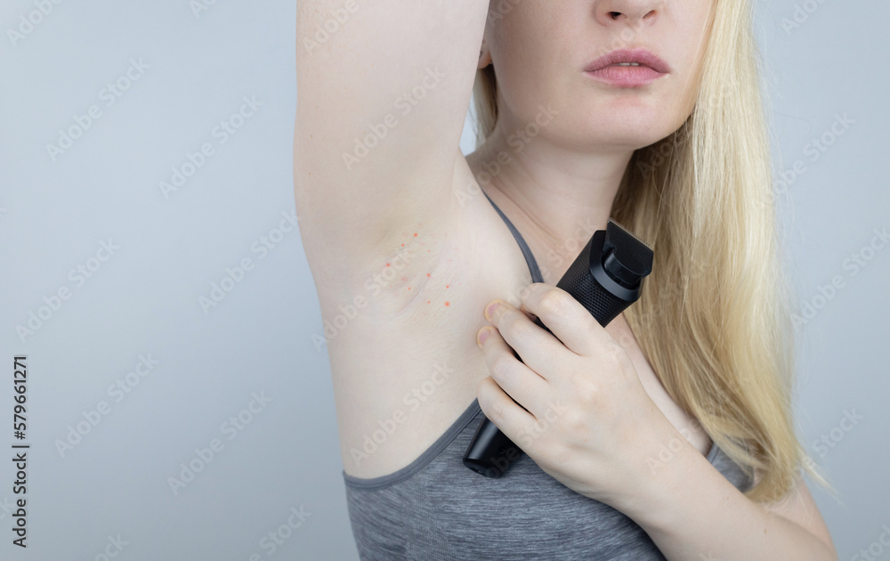 Armpit rash. Underarm skin irritation. Blonde girl shows irritation on the skin after using a