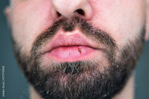 a cracked lip in a bearded man