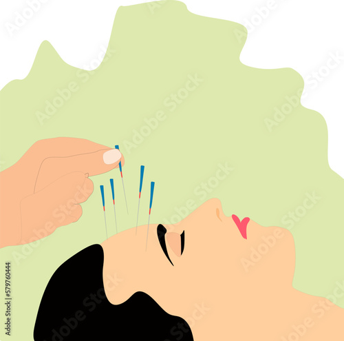 Vector of women undergoing  acupuncture treatment, needles inserted into skin of her forehead.