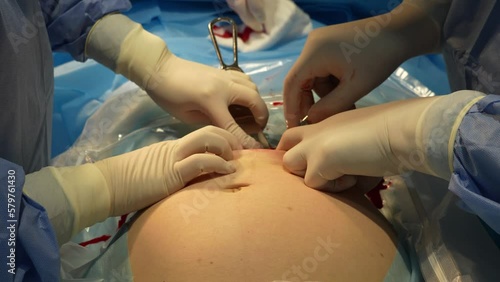 Opening of the fetal bladder during caesarean section. Intraperitoneal caesarean section with a close-up transverse incision of the lower segment of the uterus. The process of giving birth.  photo