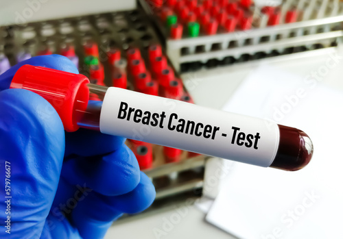 Scientist holding blood sample for Breast cancer test, CA-15.3. photo