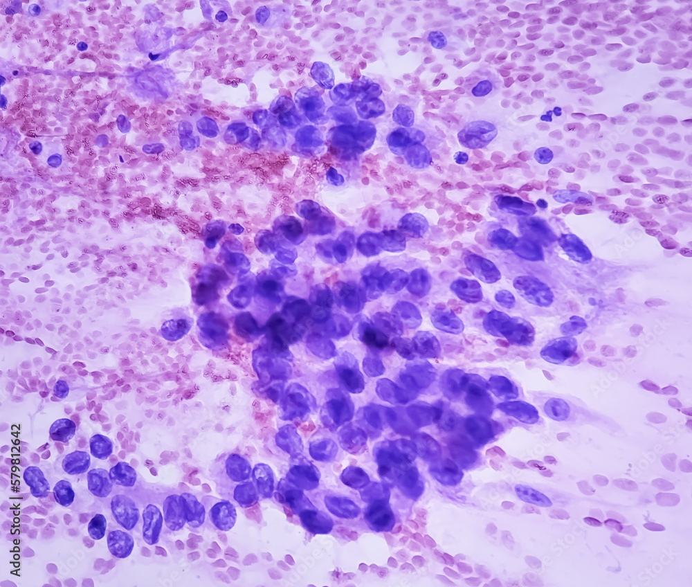 Photomicrograph of fine needle aspiration (FNA) cytology of a pulmonary (lung) nodule showing adenocarcinoma, a type of non small cell carcinoma.