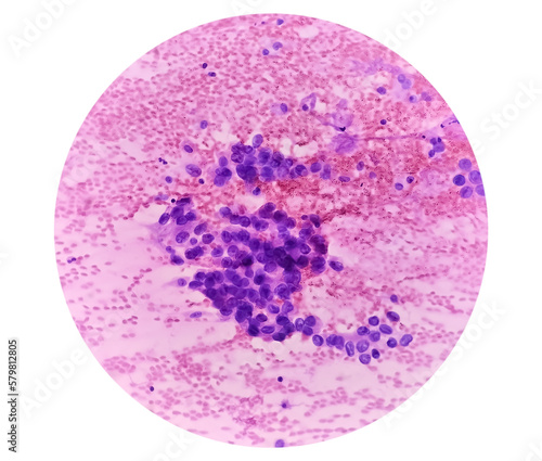 Photomicrograph of fine needle aspiration (FNA) cytology of a pulmonary (lung) nodule showing adenocarcinoma, a type of non small cell carcinoma.