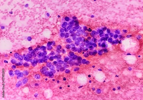 Photomicrograph of fine needle aspiration (FNA) cytology of a pulmonary (lung) nodule showing adenocarcinoma, a type of non small cell carcinoma. photo