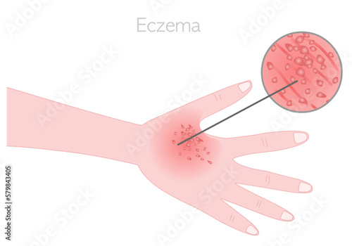 Eczema, atopic dermatitis. Itchiness, redness, rash on hand, feet. Different types of skin swelling. Dermatological diseases. Signs of scabies. Detailed lens. Illustration vector