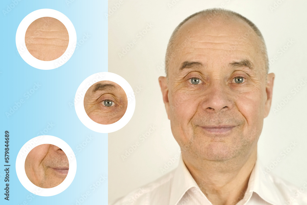 Foto Stock elderly caucasian male face with puffiness under eyes and