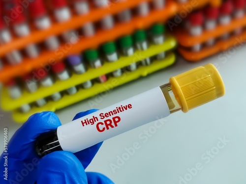 Blood sample tube for hs-CRP (high sensitive - CRP) test, for the diagnosis of inflammatory heart disease