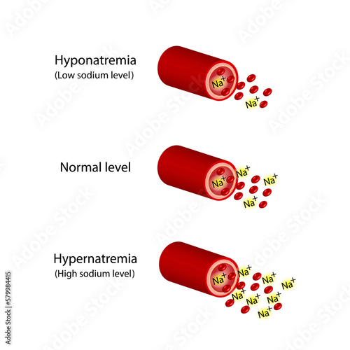 Hypernatremia, high plasma sodium level and Hyponatremia, low plasma sodium level. Sodium Na excess and deficit electrolyte disorders, blood test tube, Scientific design. Vector illustration.