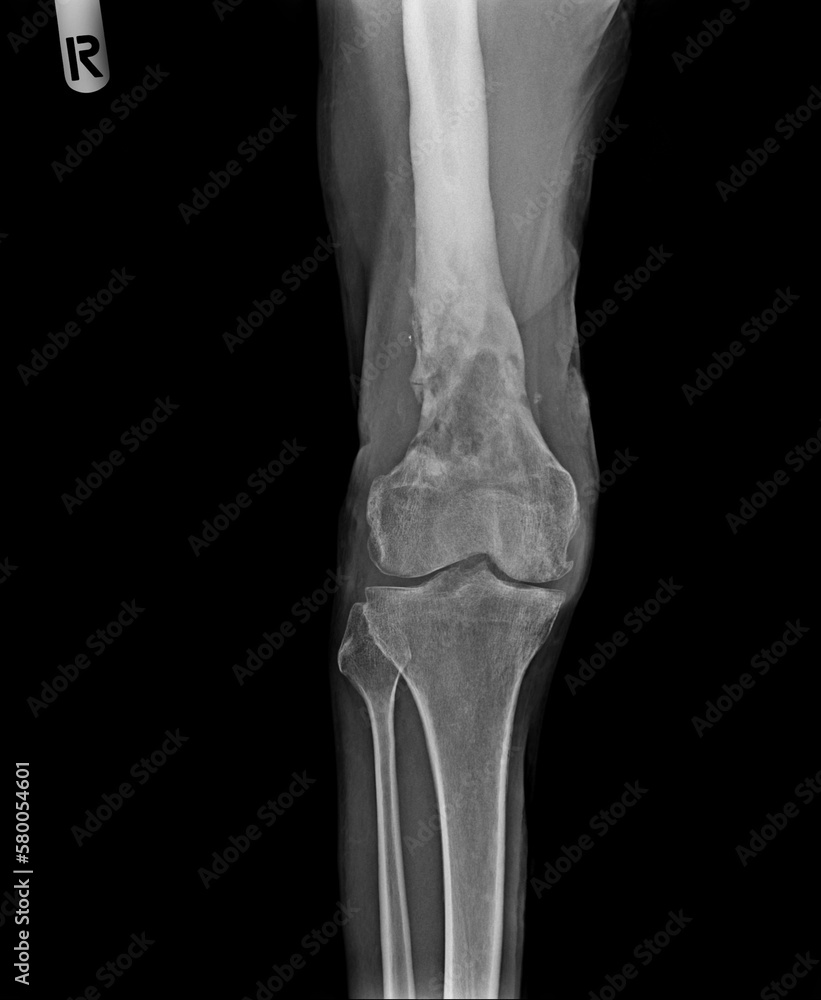 Knee Osteoarthritis. Film x-ray of osteoarthritis knee patient and artificial joint . Isolated background . Knee Osteoarthritis. Film x-ray of osteoarthritis knee patient and artificial joint . Isolated background .