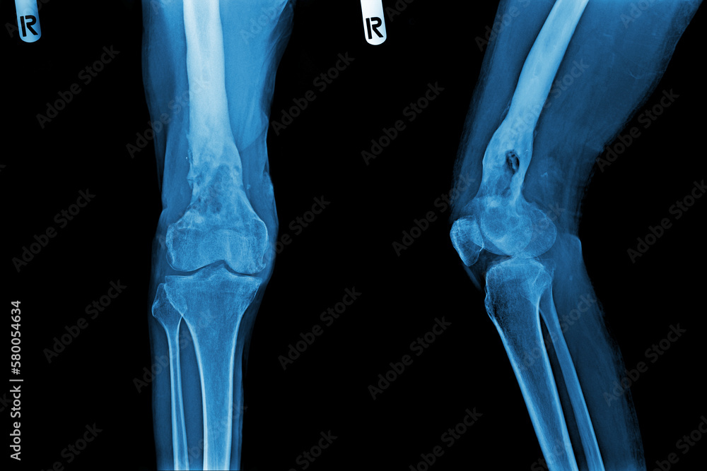 Knee Osteoarthritis. Film x-ray of osteoarthritis knee patient and artificial joint . Isolated background . Knee Osteoarthritis. Film x-ray of osteoarthritis knee patient and artificial joint . Isolated background .