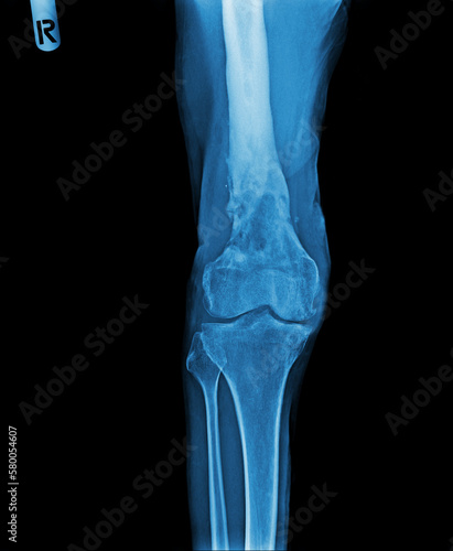Knee Osteoarthritis. Film x-ray of osteoarthritis knee patient and artificial joint . Isolated background .