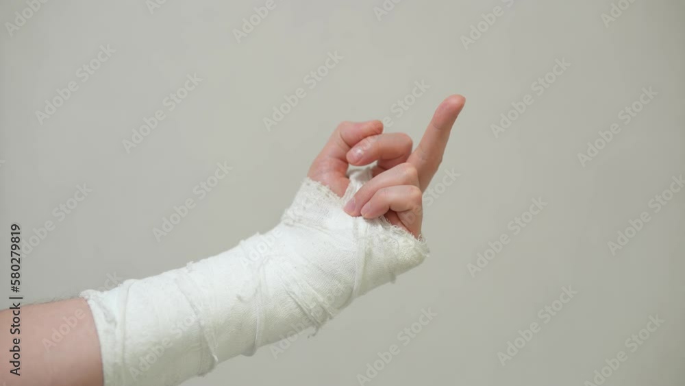 Man with plaster cast on arm. A broken arm in plaster. Man with plaster cast on arm. A broken arm in plaster.