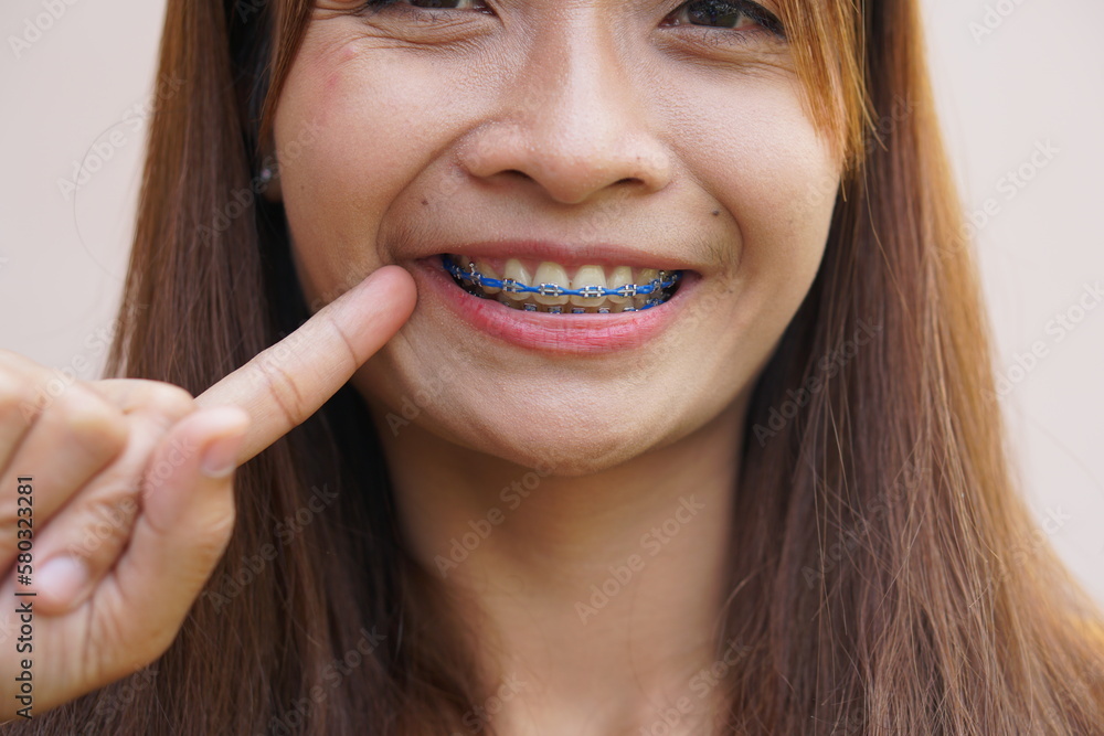 Asian woman pointing at mouth with braces Asian woman pointing at mouth with braces