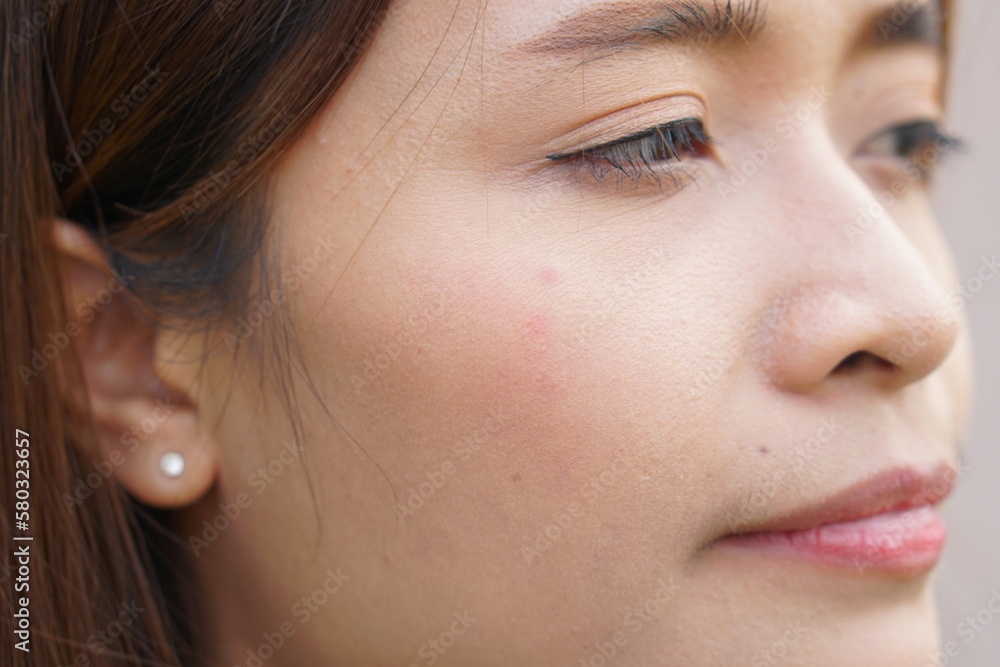 Asian woman has acne on her face Asian woman has acne on her face