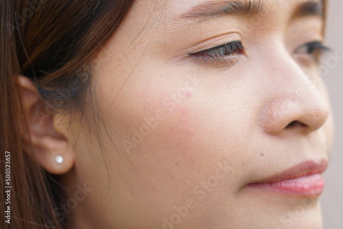 Asian woman has acne on her face