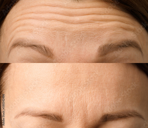 Female forehead with wrinkles