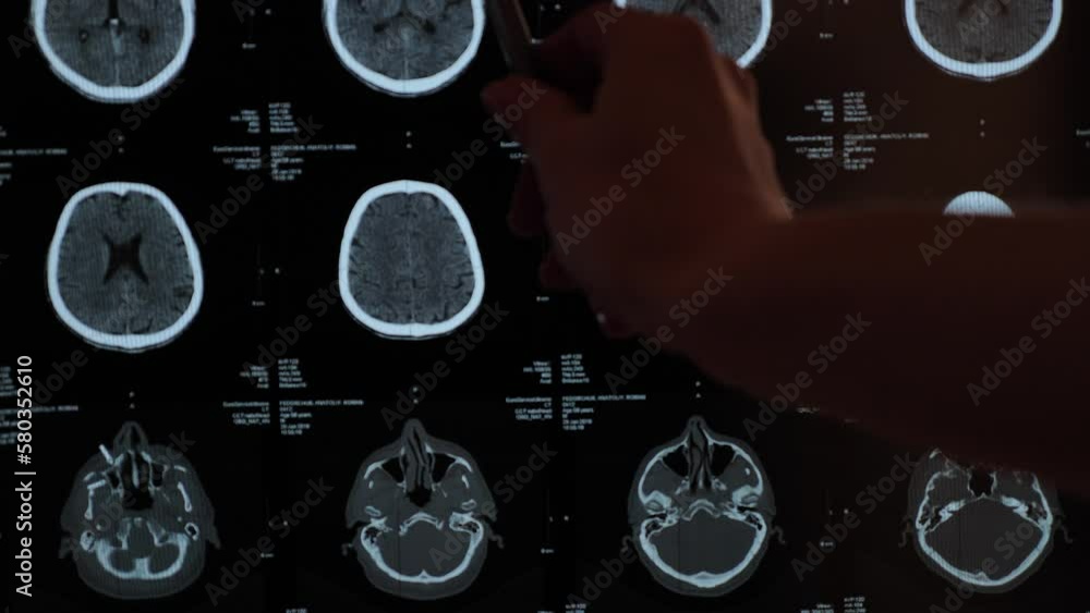 Magnetic resonance imaging of the brain from different sides, traumatic ...