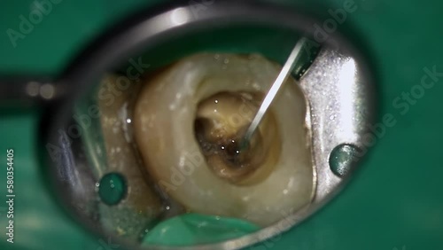 Dentist is filling hole in decay tooth with special liquid medicine with irrigator to disinfect from bacterium. Macro footage of doctor treating rotten chewing molar with mirror and probe in clinic photo