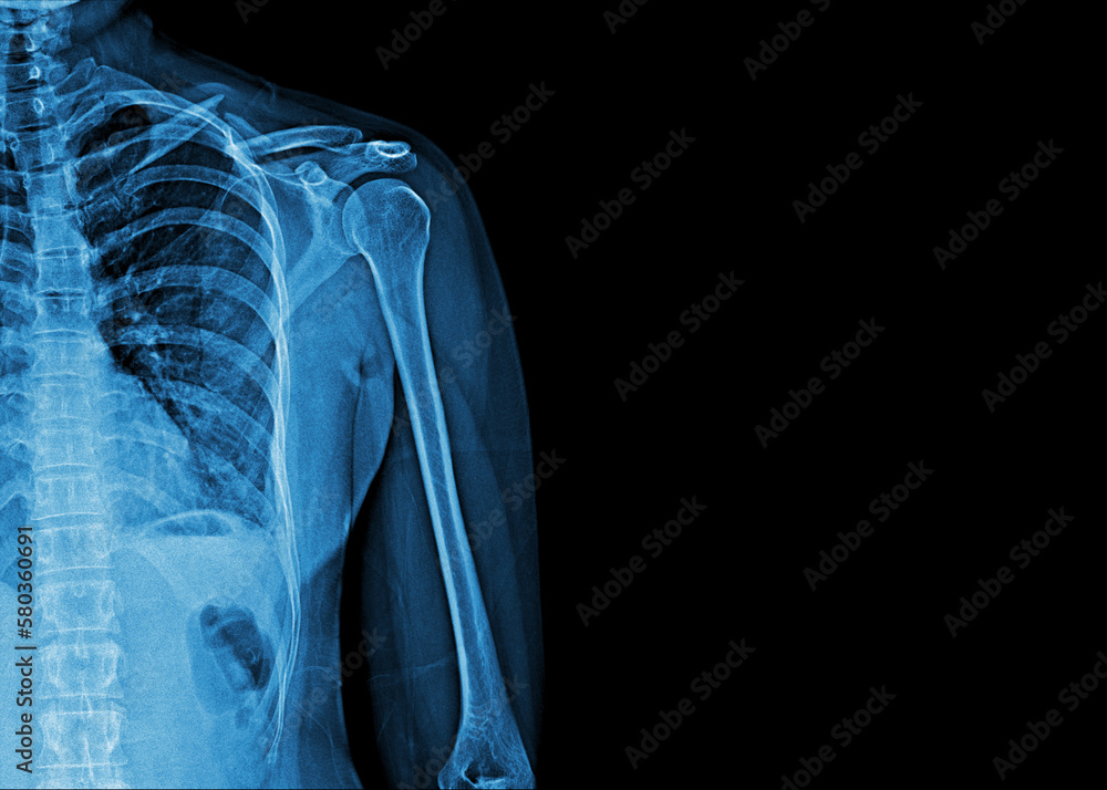 X-ray film of human shoulder - obrazy, fototapety, plakaty 