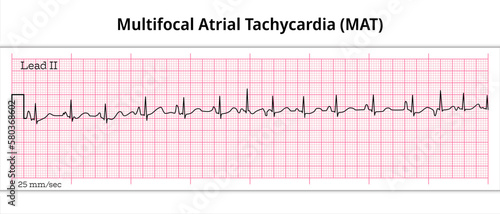 Multifocal Atrial Tachycardia (MAT) - 8 Second ECG Paper - Electrocardiography Vector Medical Illustration