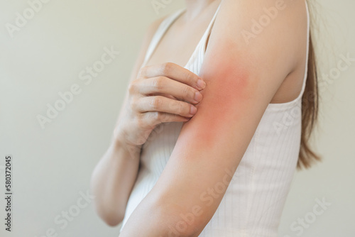 Foto Dermatology asian young woman, girl allergy, allergic reaction from atopic, insect bites on her arm, hand in scratching itchy, itch red spot or rash of skin