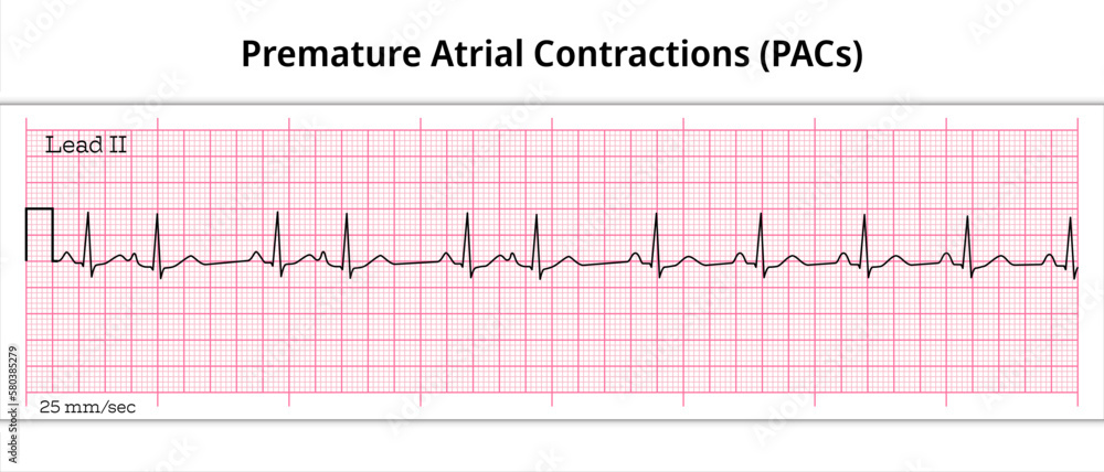 Obraz Premature Atrial Contractions Pacs Premature Atrial Complex Pac Second Ecg Paper