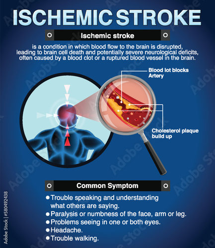 Informative poster of Ischemic stroke