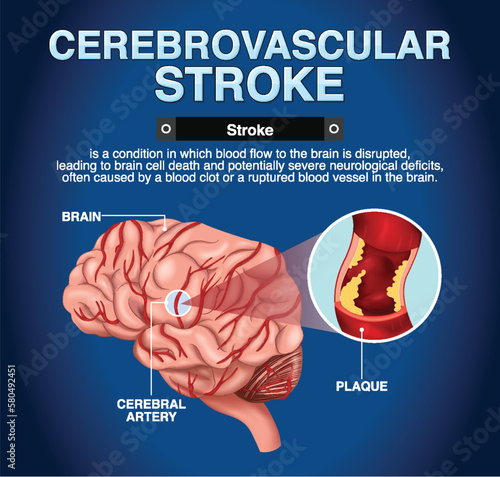 Informative poster of Cerebrovascular stroke05