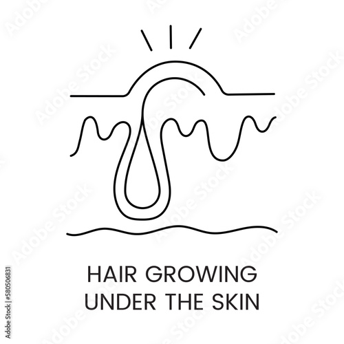 Tendency to ingrown hairs line icon in vector, illustration for laser cosmetology clinic tendency to ingrown hairs.