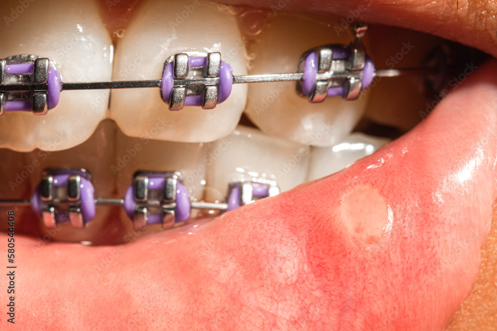 Mouth ulcers are a common issue that can occur when someone has braces