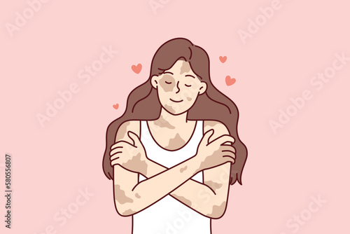 Positive girl with vitiligo disease hugging herself taking skin diseases as personal feature. Concepts of body positivity in people suffering from dermatological illness or vitiligo syndrome 