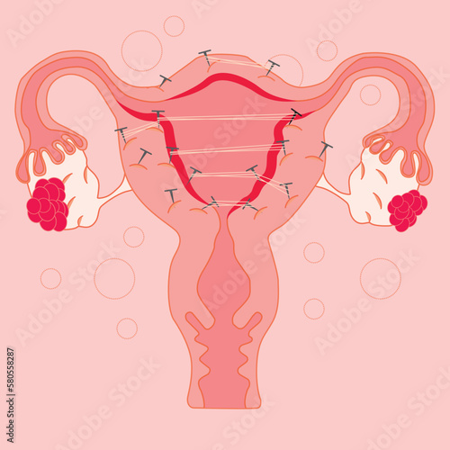 A pink illustration of a uterus with the nails in the middle