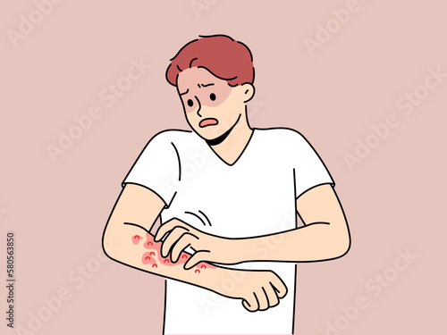 Unhealthy man scratch red pimples on arm suffer from allergy or dermatitis. Stressed unwell guy suffer from itchiness and redness. Healthcare. Vector illustration. 