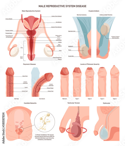 Male reproductive system disorder set. External and internal organs photo