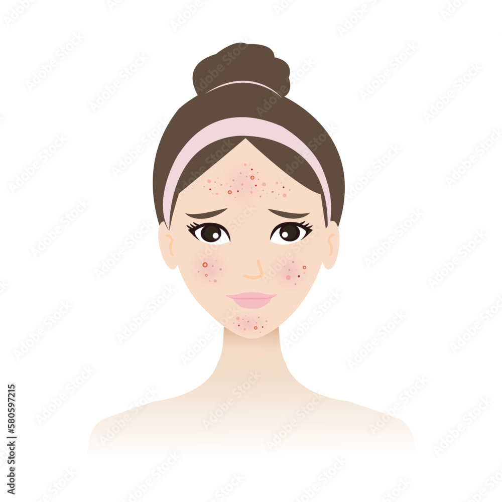 The woman face with skin acne vector isolated on white background. Acne, pimples, blackheads, comedones, whiteheads, papule, pustule, nodule and cyst on face. Skin problem concept illustration. The woman face with skin acne vector isolated on white background. Acne, pimples, blackheads, comedones, whiteheads, papule, pustule, nodule and cyst on face. Skin problem concept illustration.