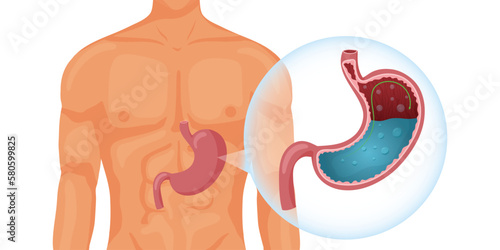 Full human stomach in body